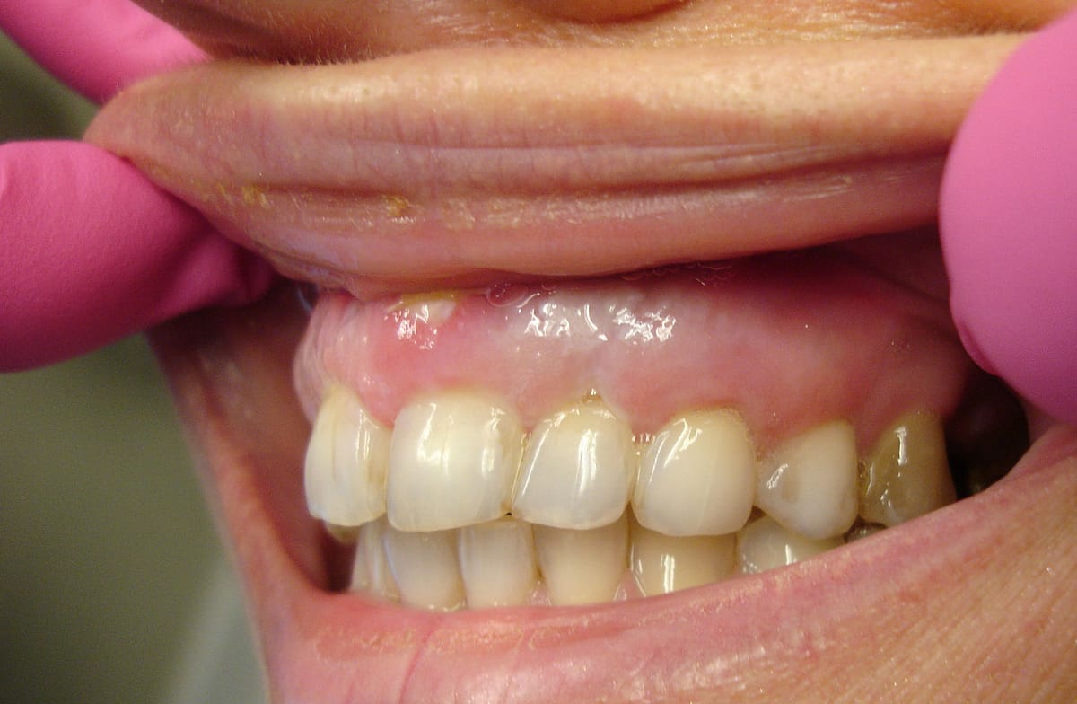 teeth profile 2 week pta