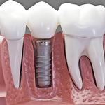 What Dental Implant Packages Can I Expect?