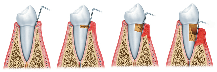 Stages of Periodontal Disease ​