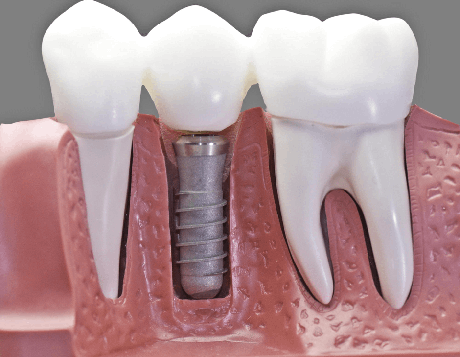 What Dental Implant Packages Can I Expect?