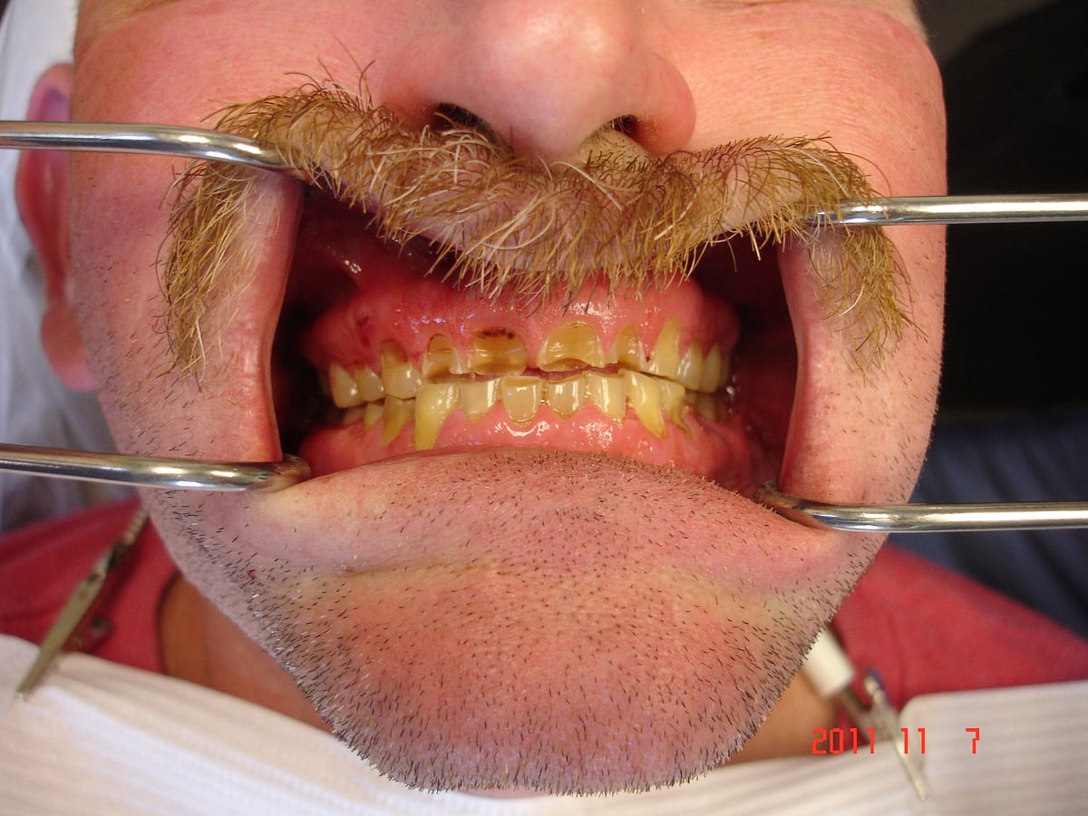 man with mustache teeth profile cavities