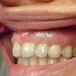 teeth profile 2 week pta