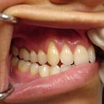 dentist holding mouth open after implant surgery