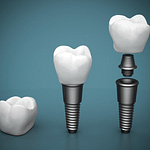 Dental Implants Near Me - How to Find the Best Ones