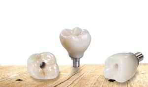 dental implants showing screws at bottom of teeth