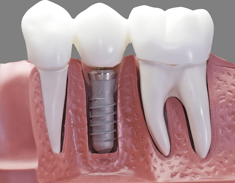 Can You Have Dental Implants with Periodontal Disease?